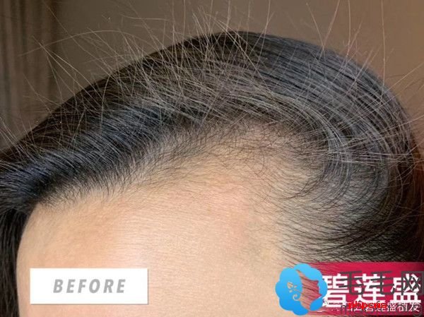 海口の碧莲盛で額の両側の植毛を受けた女性の術前の生え際。元のBEFOREラベルとブランドの透かしを保持