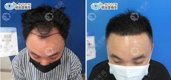 碧莲盛の男性のBHT植毛の術前・術後比較。青い背景で頭を下げた正面の近接写真。左右とも前頭部と額の両側が見える