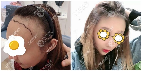 青島の大麦の女性の生え際2,800株の比較写真。左は術前のデザイン、右は術後4か月に髪を分けて生え際を見せた写真