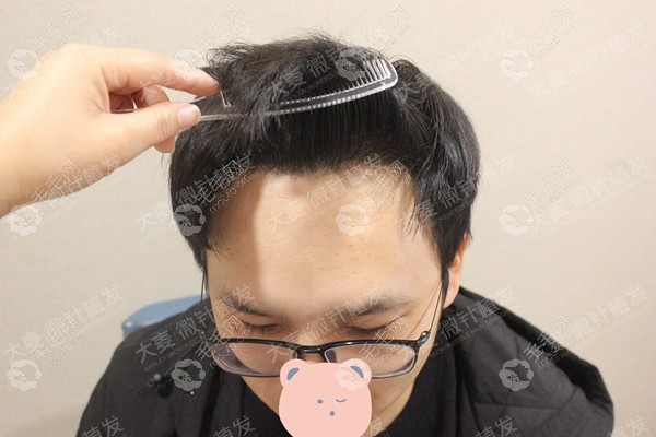 同じ男性に2,400株を移植して1年4か月後。くしで髪を分けて生え際を見せた近接写真