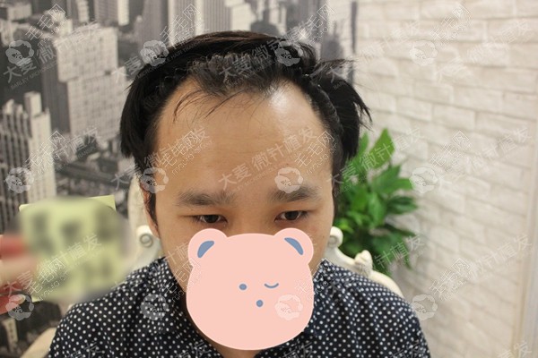 揚州の大麦の男性症例の術前写真。額の両側と前頭部の薄毛が見える