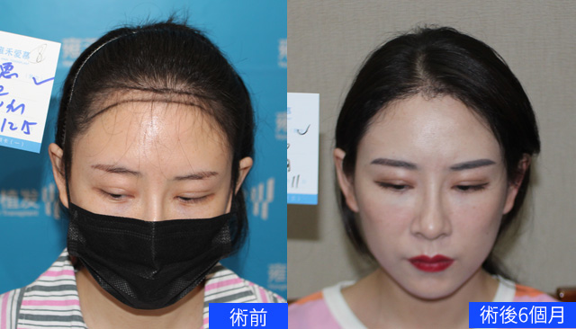 雍禾公式サイトの于さんの生え際の植毛比較。左は術前、右は術後6か月。元の写真の時期ラベルを保持