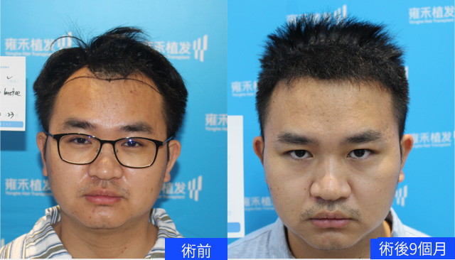 雍禾公式サイトの劉さんのM字部分の植毛比較。左は術前、右は術後9か月。元の写真の時期ラベルを保持